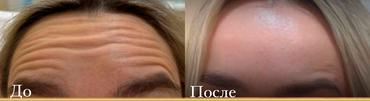 Коррекция морщин ботулотоксином