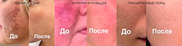 Хотите избавиться от несовершенств кожи всего за 2-3 процедуры?