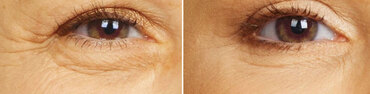 SmoothEye - лазерное омоложение кожи вокруг глаз и параорбитальной области.