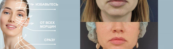 Ботулинотерапия Full Face – комплексное омоложение лица
